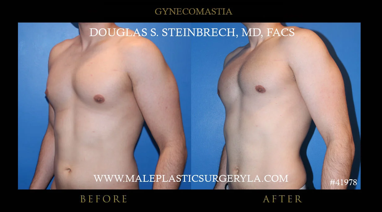 Gynecomastia - Before & After Photos