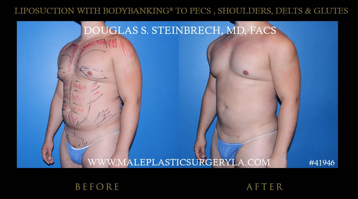 Liposuction - Before & After Photos