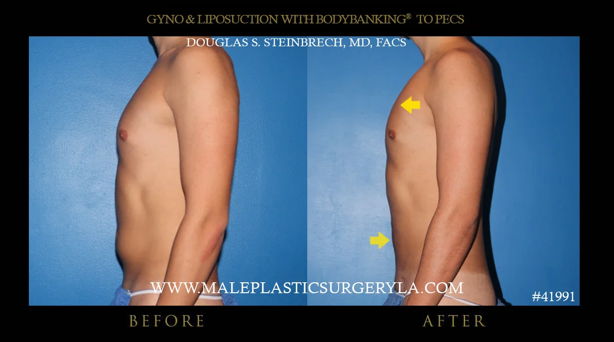 Gynecomastia - Before & After Photos