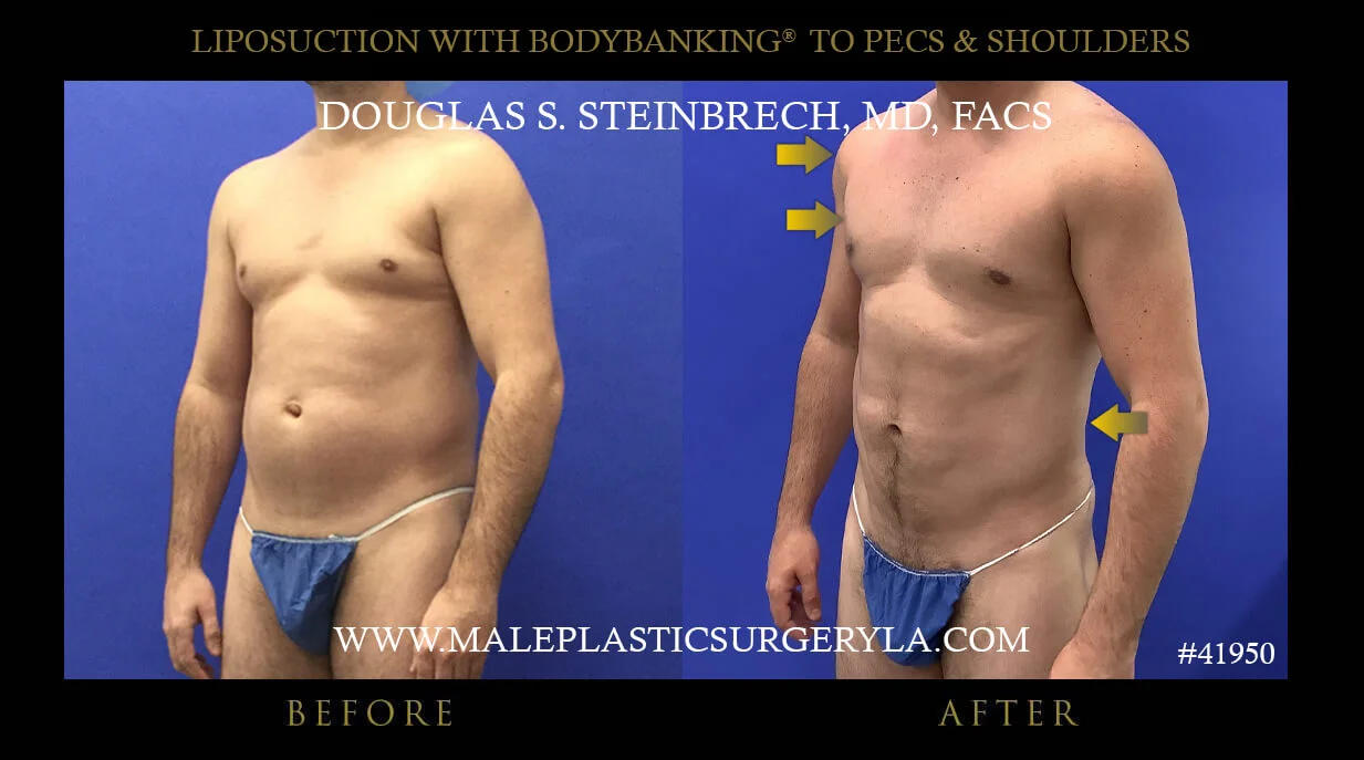 Liposuction - Before & After Photos