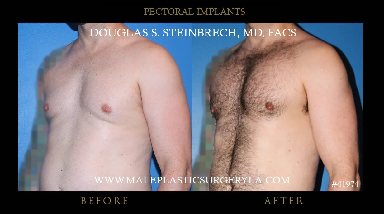 Pectoral Chest Implant - Before & After Photos