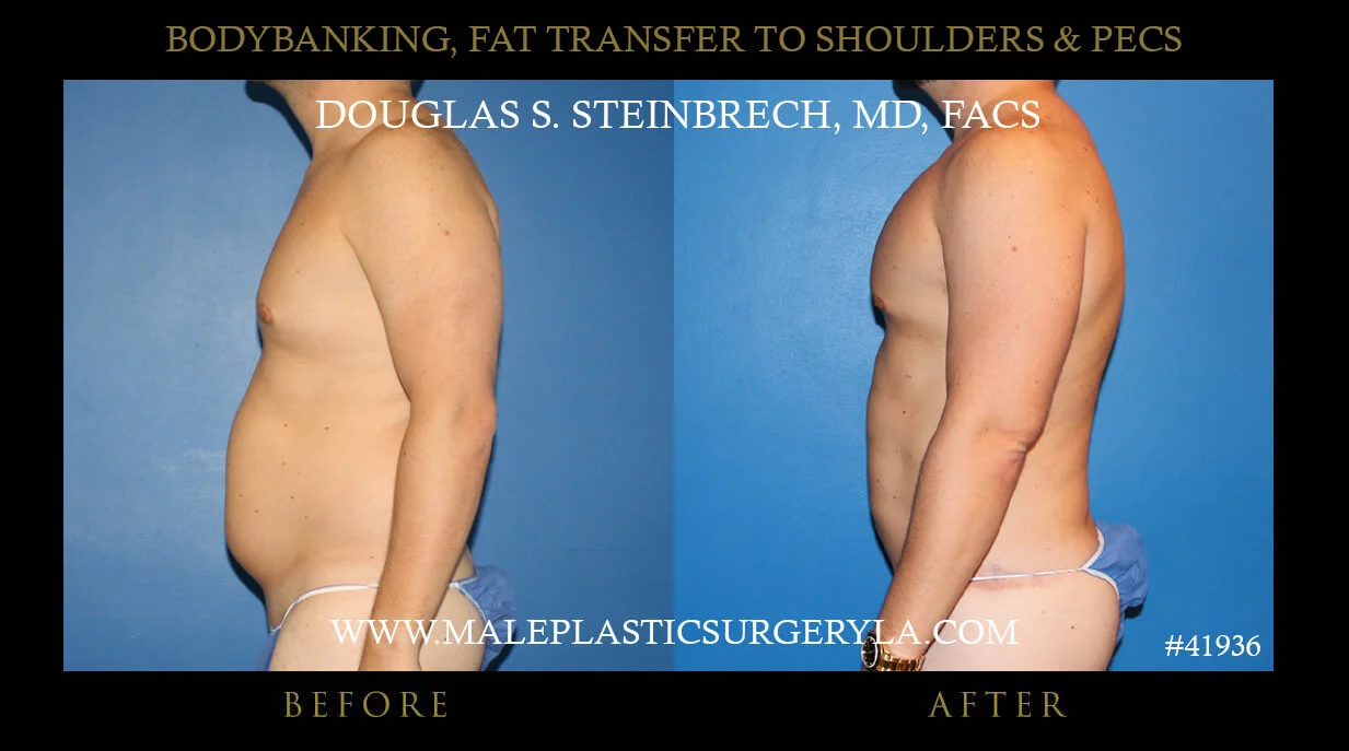 Liposuction - Before & After Photos