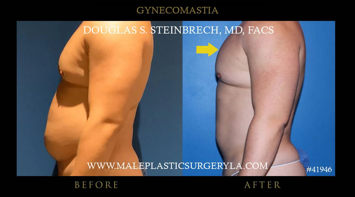 Gynecomastia - Before & After Photos