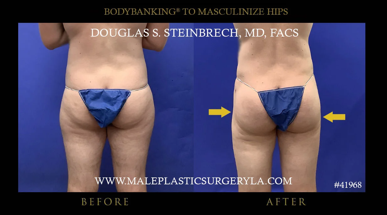 Liposuction - Before & After Photos