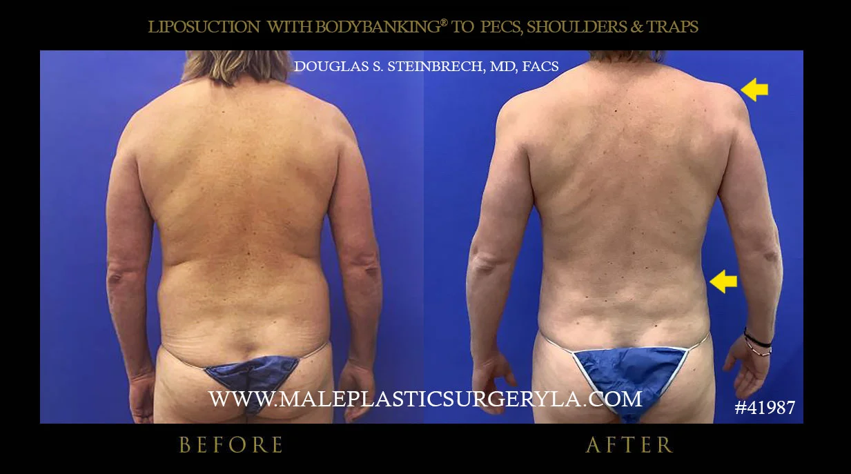 Liposuction - Before & After Photos