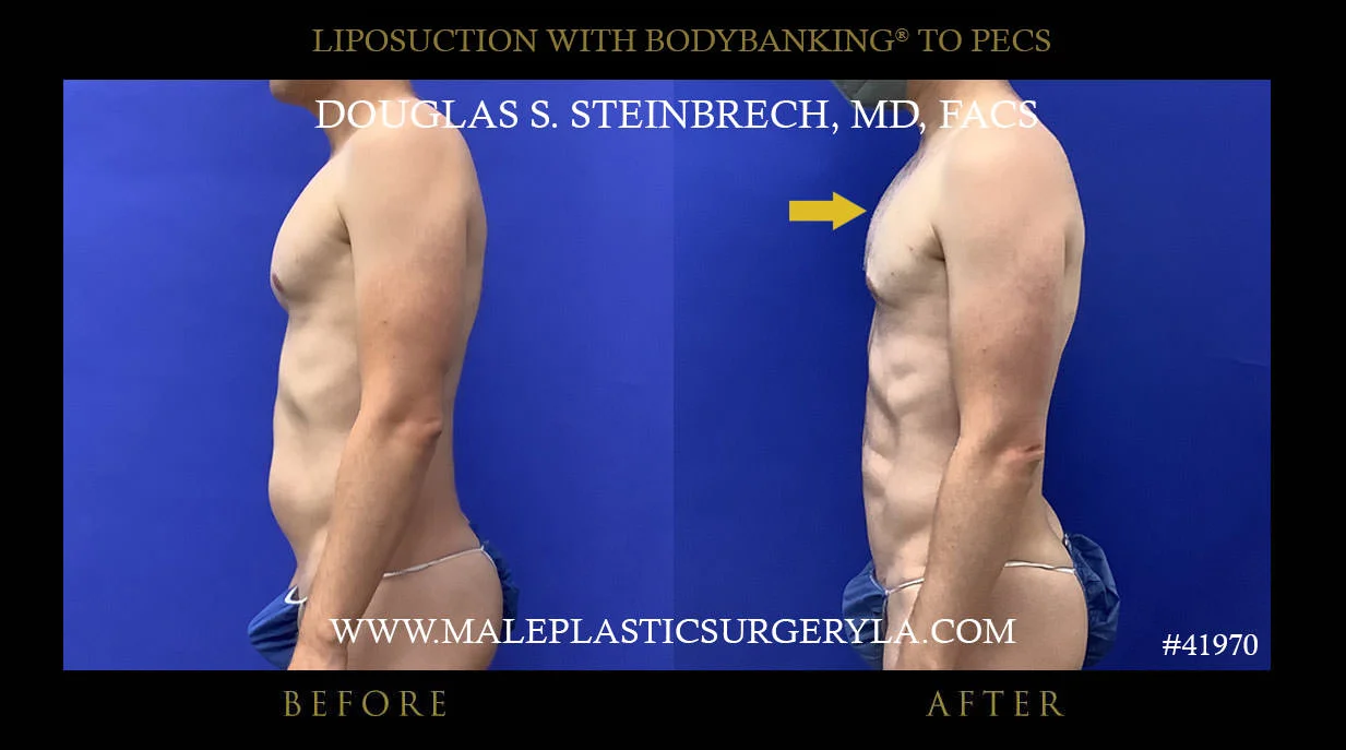 Liposuction - Before & After Photos