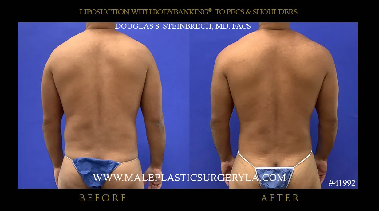 Liposuction - Before & After Photos