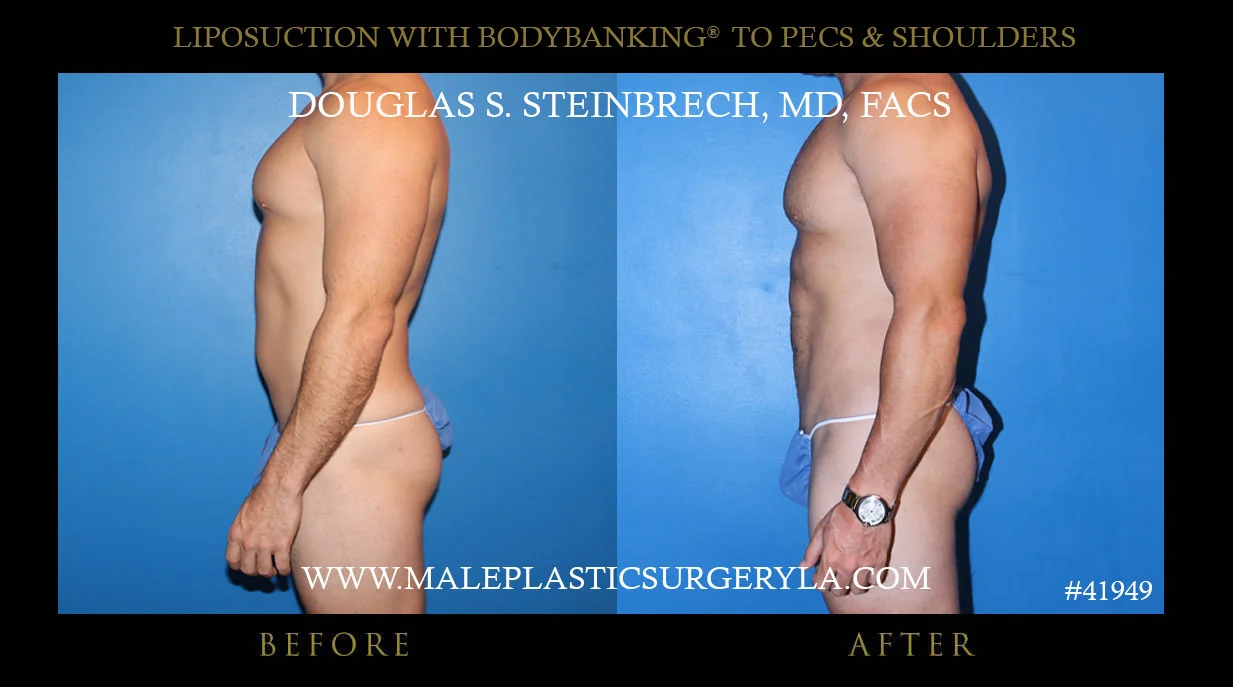 Liposuction - Before & After Photos