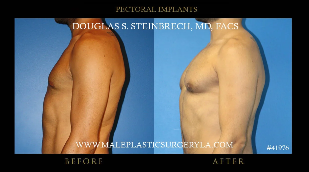 Pectoral Chest Implant - Before & After Photos