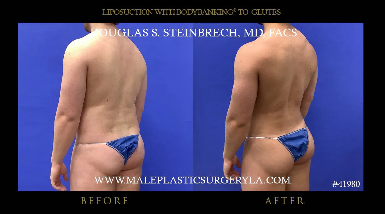 Liposuction - Before & After Photos