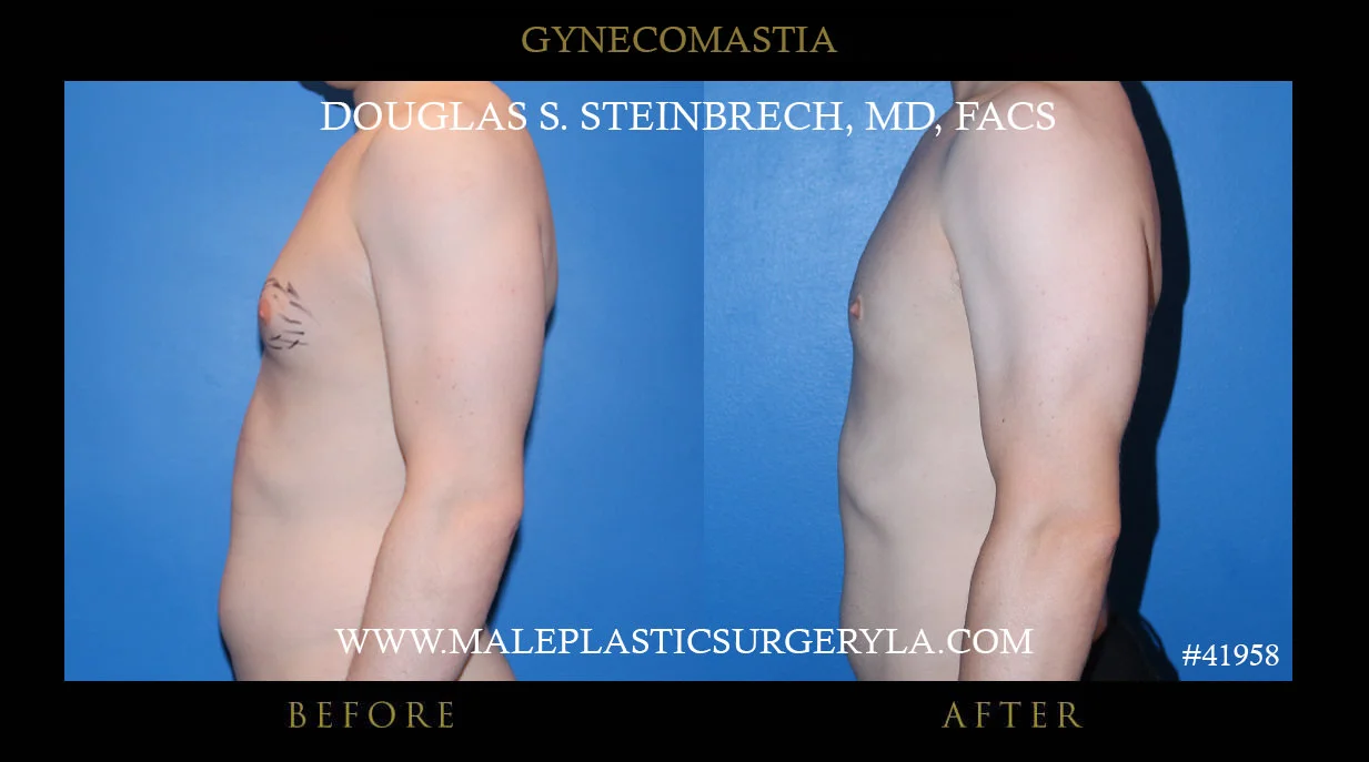 Gynecomastia - Before & After Photos