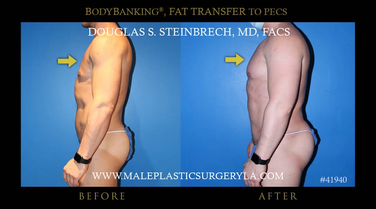 Liposuction - Before & After Photos