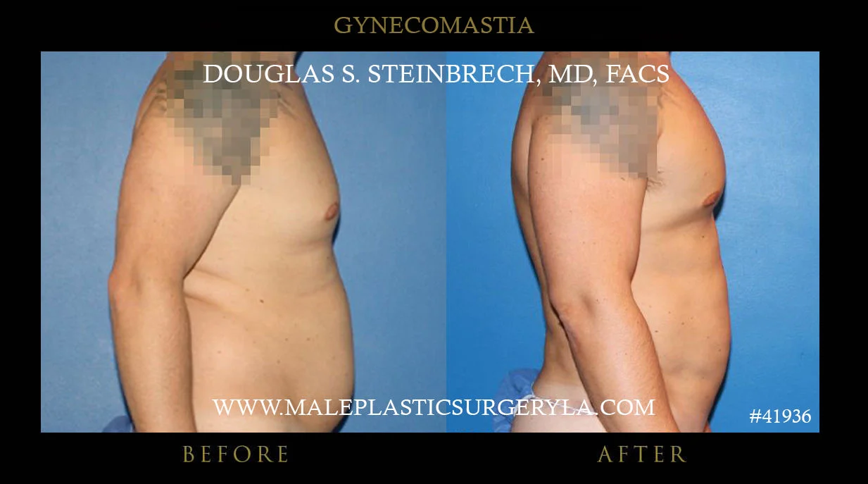 Gynecomastia - Before & After Photos