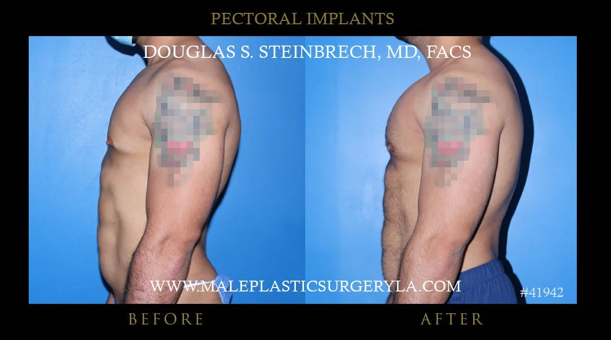 Pectoral Chest Implant - Before & After Photos