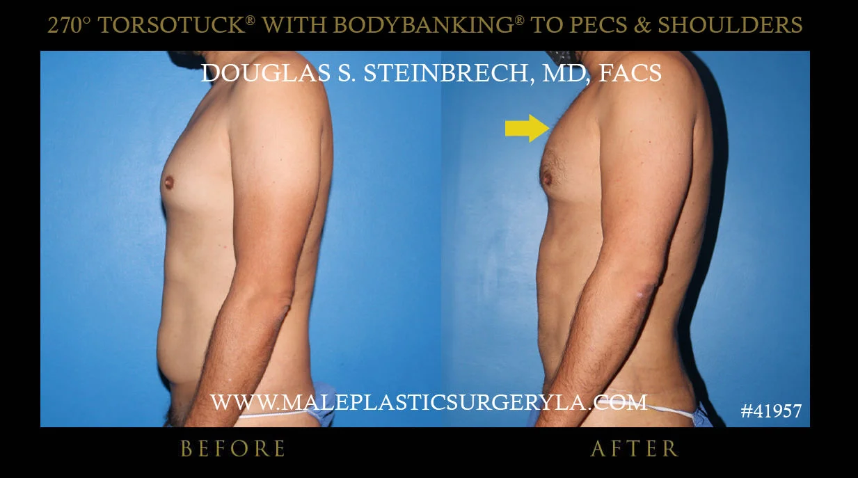 Gynecomastia - Before & After Photos