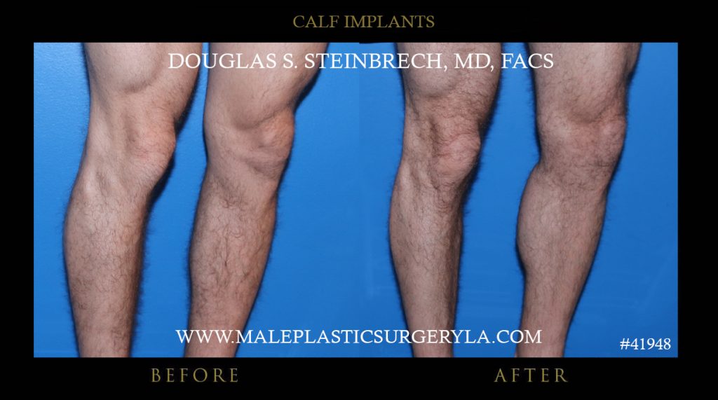 Calf Implants Before and After Photos