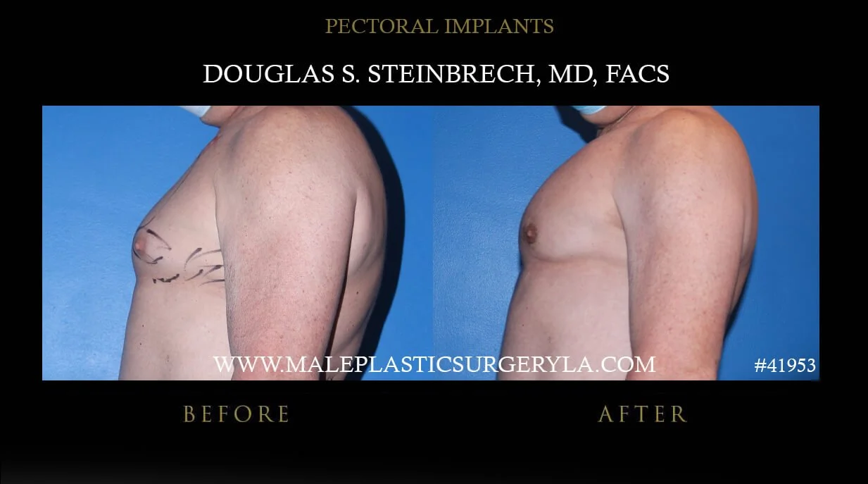 Pectoral Chest Implant - Before & After Photos