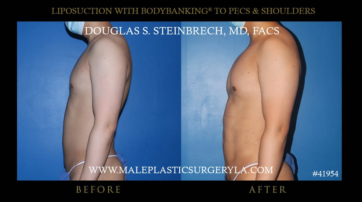 Liposuction - Before & After Photos