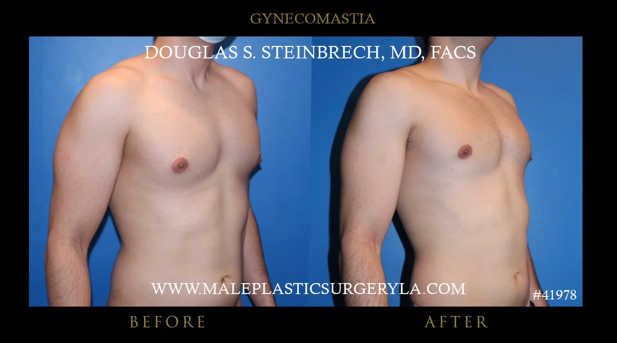 Gynecomastia - Before & After Photos