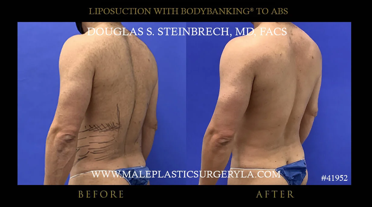 Liposuction - Before & After Photos