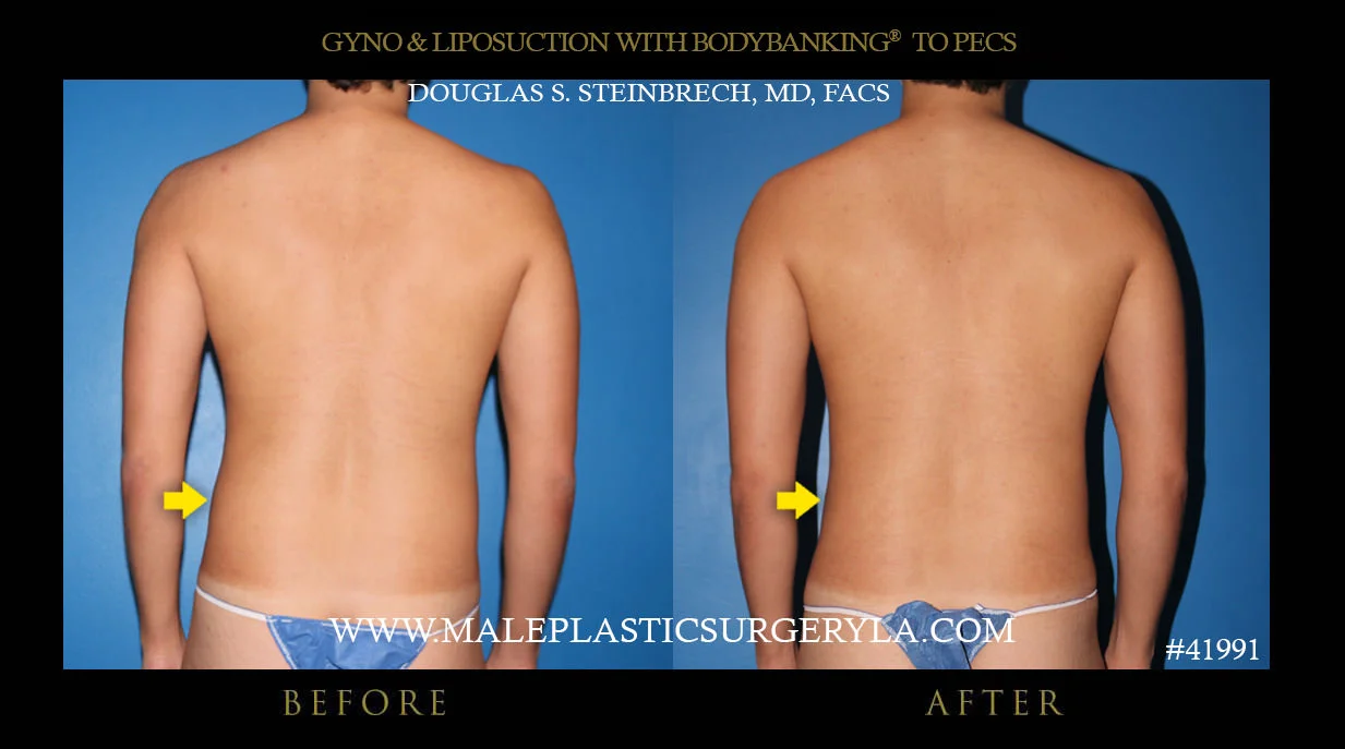 Gynecomastia - Before & After Photos