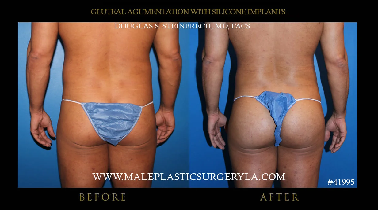 male gluteal augmentation: the ultimate way to achieve your body butt goals in shape