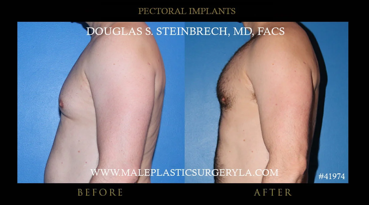 Pectoral Chest Implant - Before & After Photos