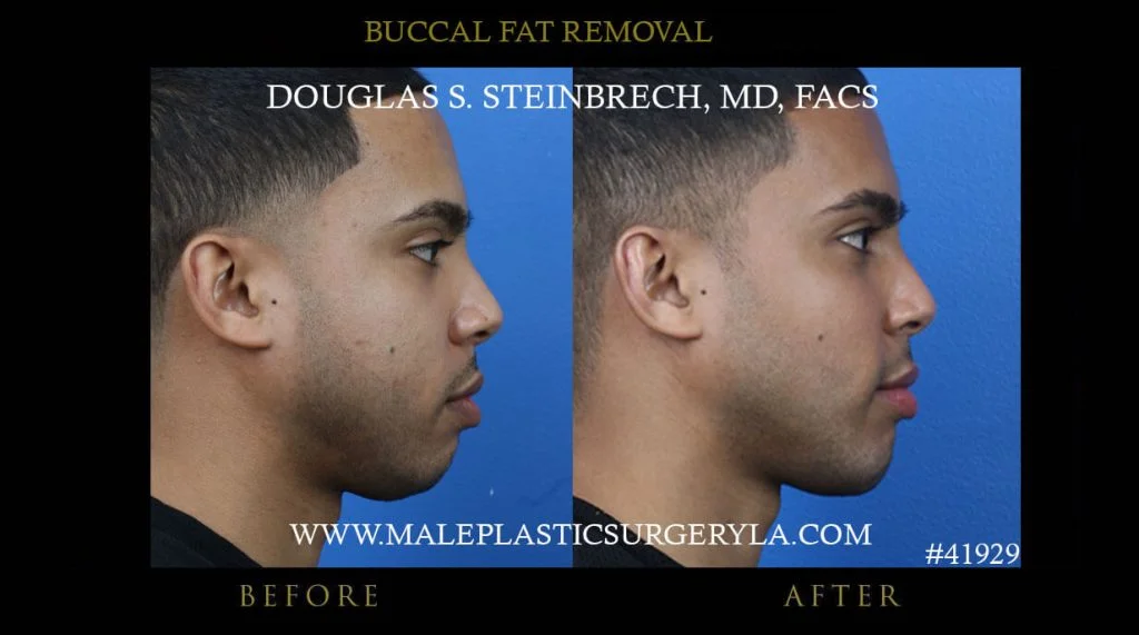 Buccal Fat Removal - Before & After Photos