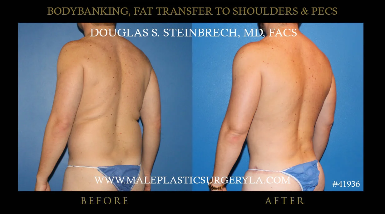 Liposuction - Before & After Photos