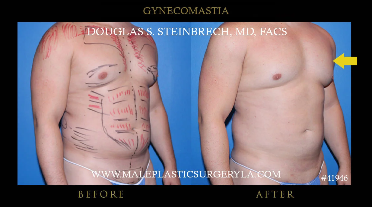 Gynecomastia - Before & After Photos