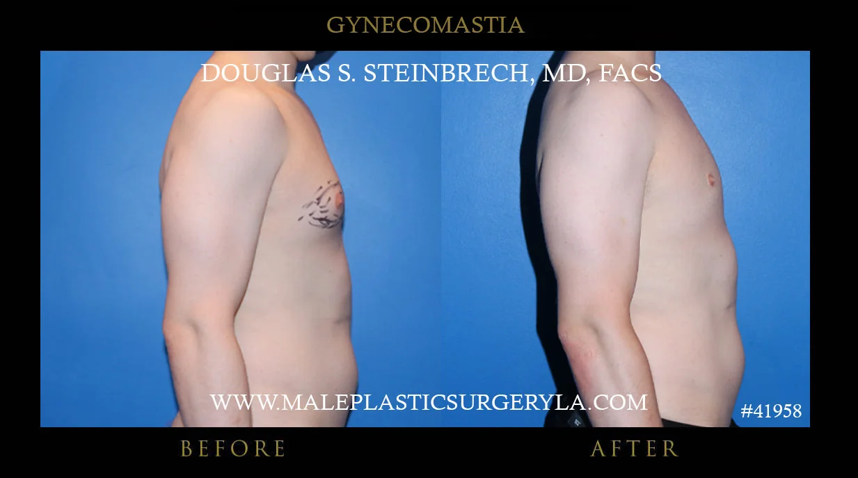 Gynecomastia - Before & After Photos