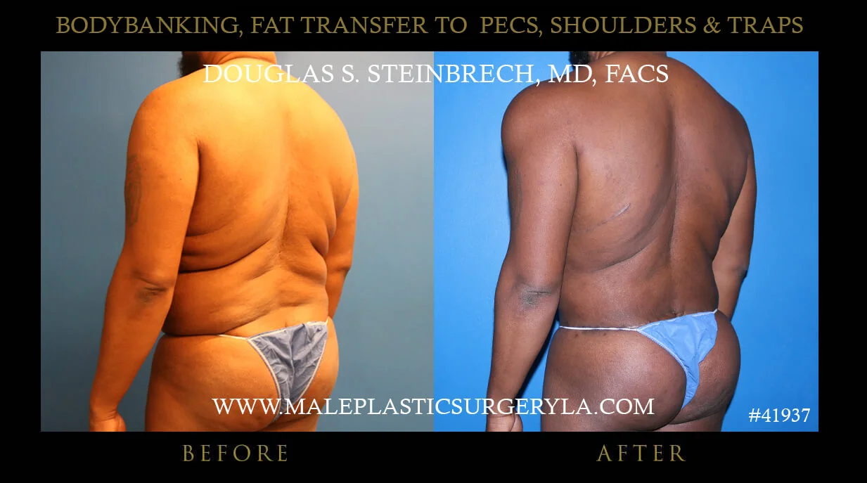 Liposuction - Before & After Photos