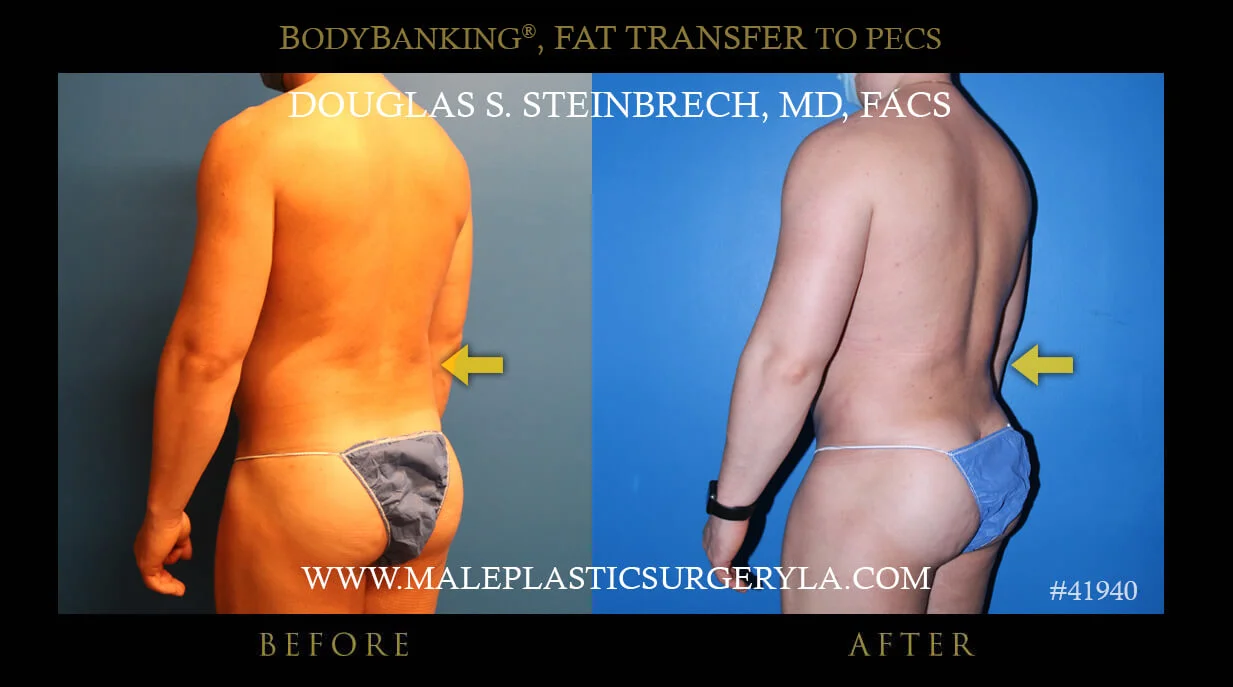 Liposuction - Before & After Photos