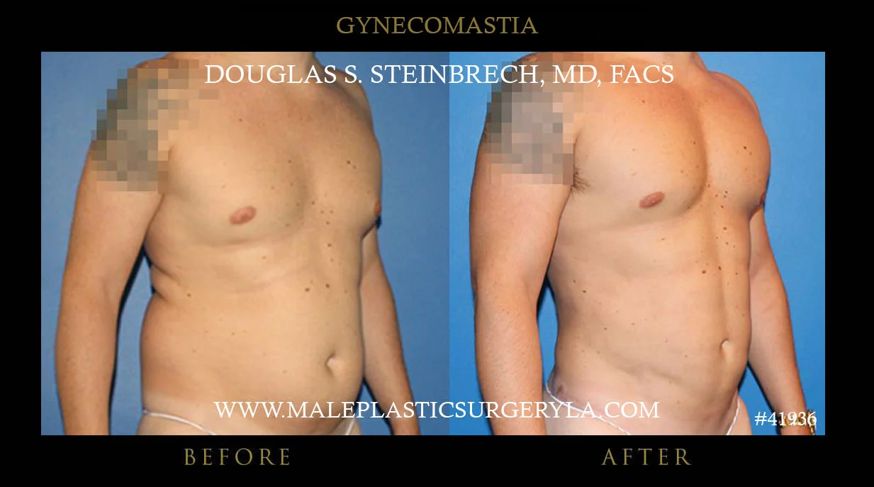 Gynecomastia - Before & After Photos