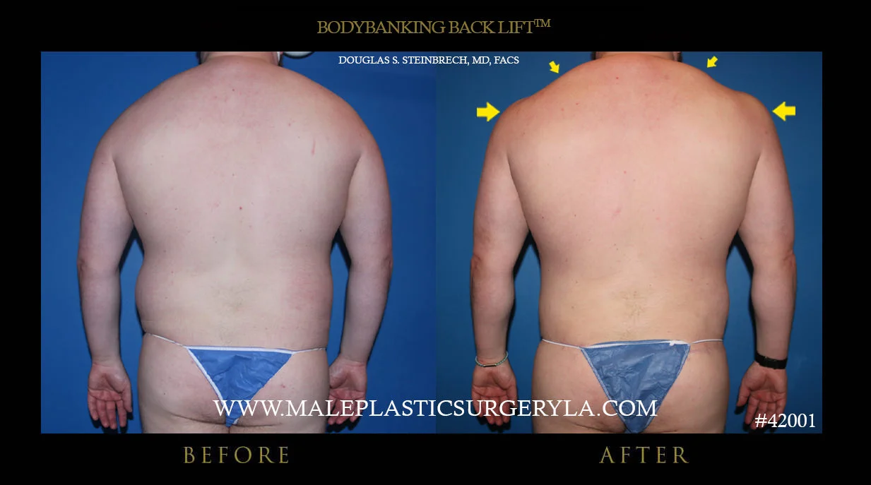 BodyBanking Back Lift - Before & After Photos