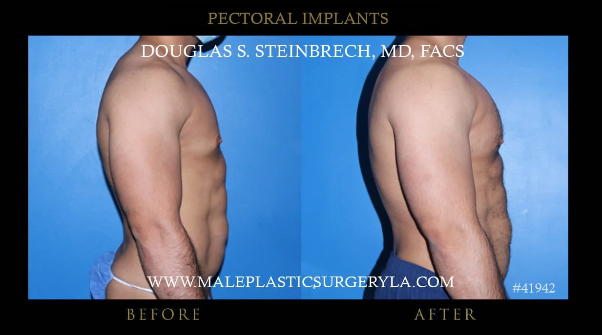 Pectoral Chest Implant - Before & After Photos