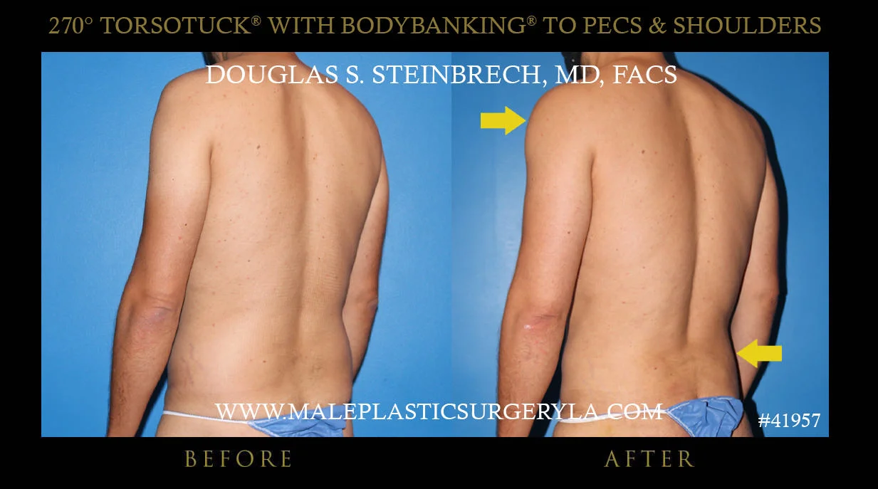 Gynecomastia - Before & After Photos