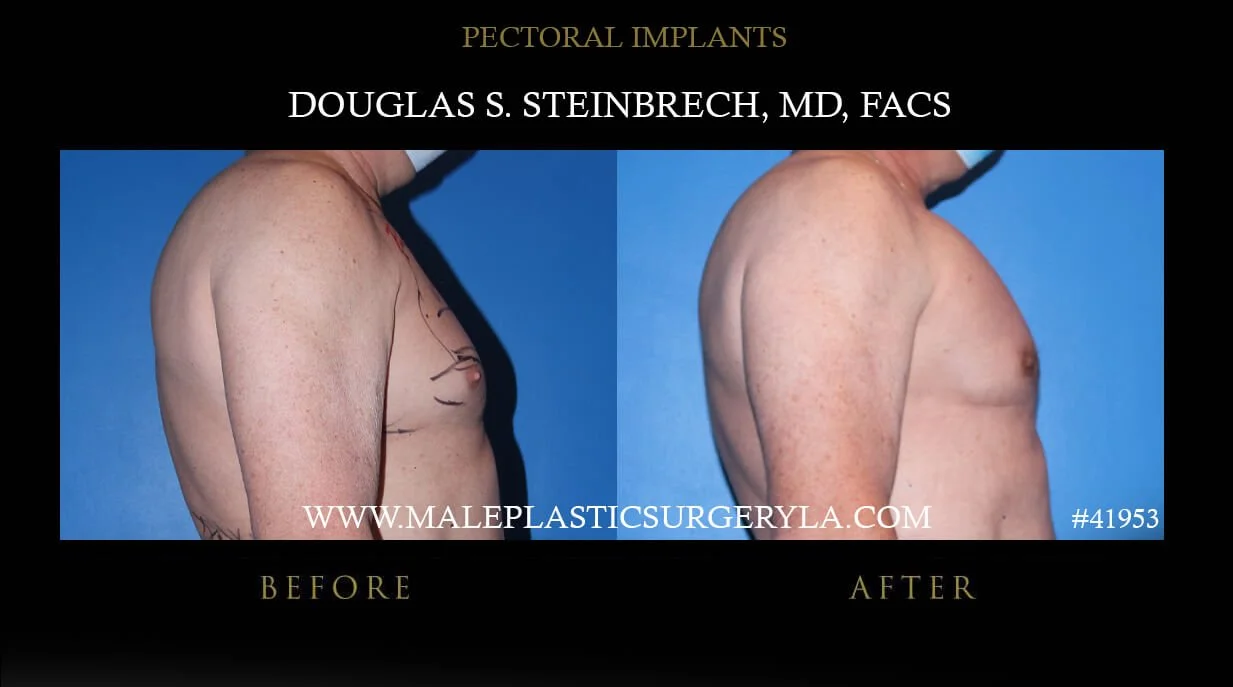 Pectoral Chest Implant - Before & After Photos