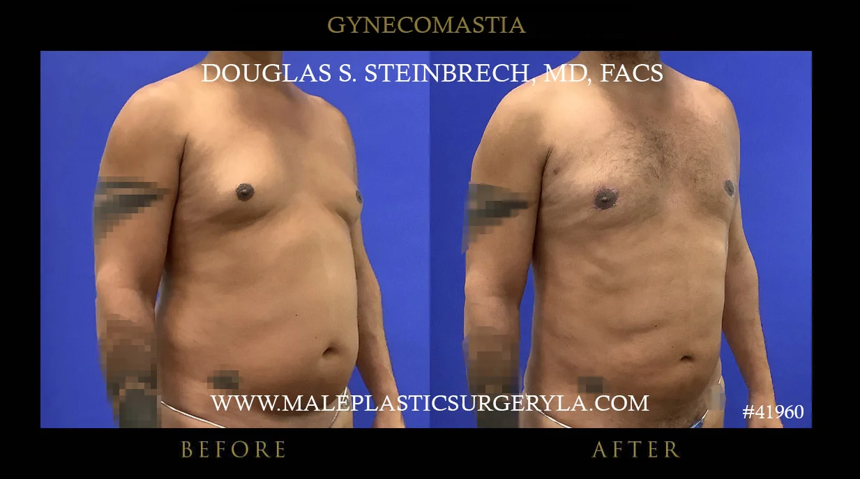 Gynecomastia - Before & After Photos