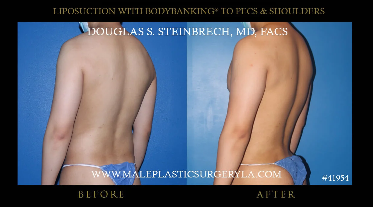 Liposuction - Before & After Photos