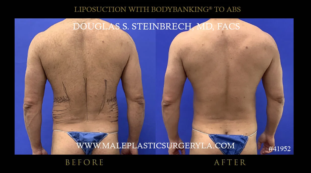 Liposuction - Before & After Photos