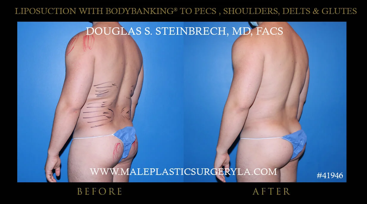 Liposuction - Before & After Photos