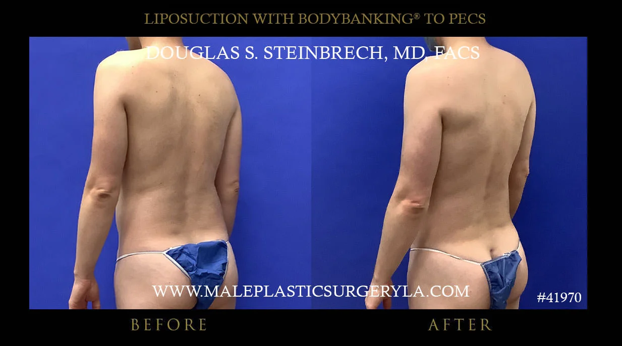 Liposuction - Before & After Photos