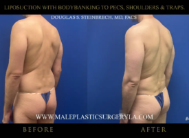 4-lipo-bodybanking-to-pecs-shoulders-traps-135-angle-la