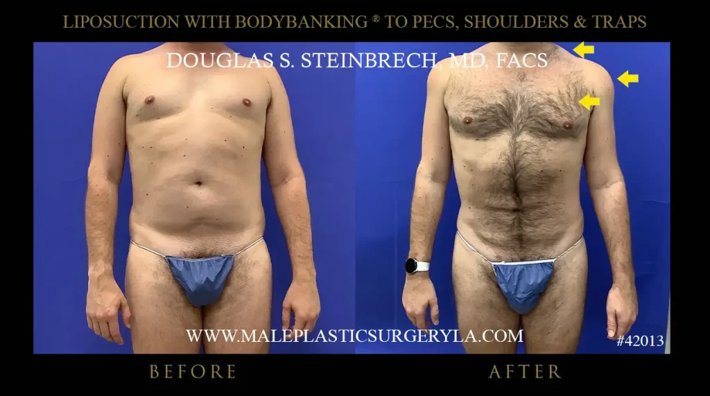 Liposuction - Before & After Photos