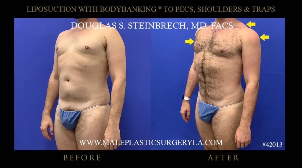 Liposuction - Before & After Photos