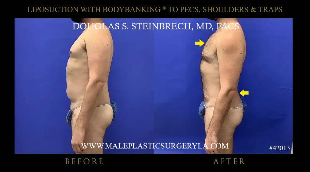 Liposuction - Before & After Photos