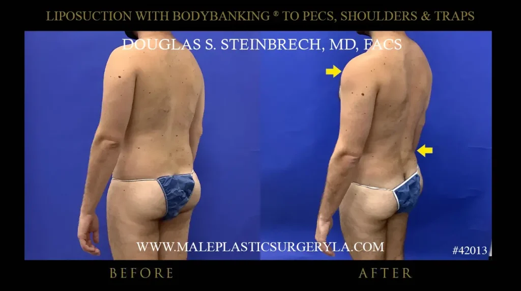 Liposuction - Before & After Photos