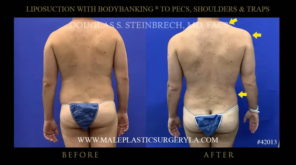 Liposuction - Before & After Photos