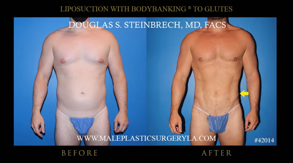 Liposuction - Before & After Photos